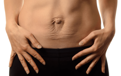 When is the Best Time to Treat Diastasis Recti?