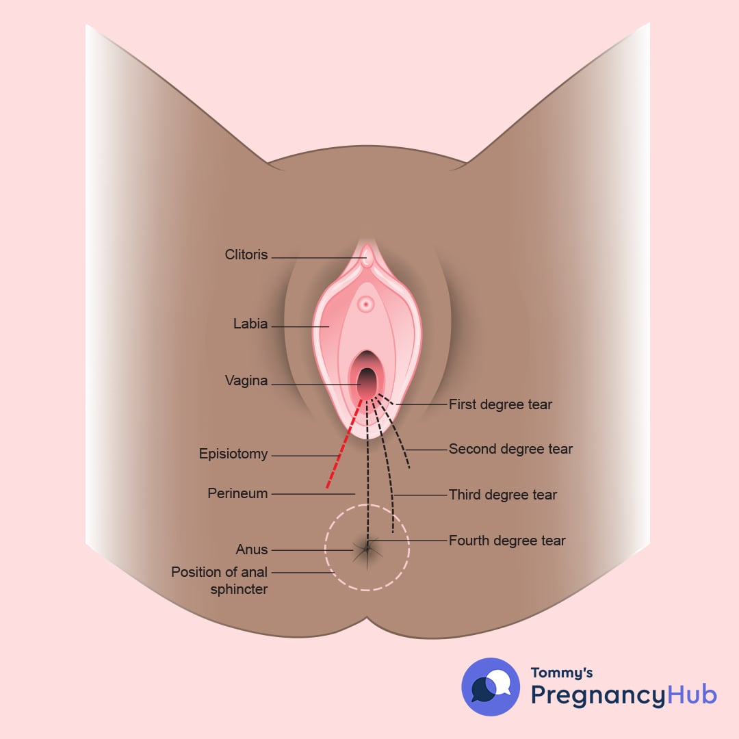 perineal tears